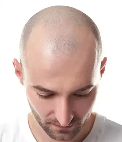 Alopecia totalis discount