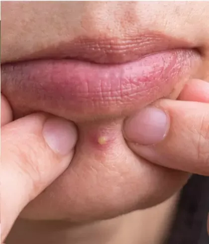 Can popping a pimple lead to acne scars?