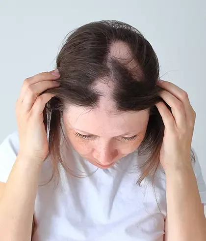 Alopecia Treatment in Homeopathy