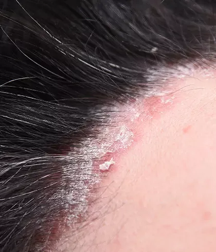 Do over-the-counter drugs work for scalp psoriasis?