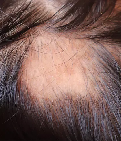 Facts about patchy hair loss | Dr Batra's™