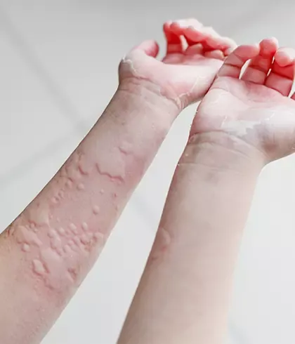 Homeopathy: Best treatment for skin allergy