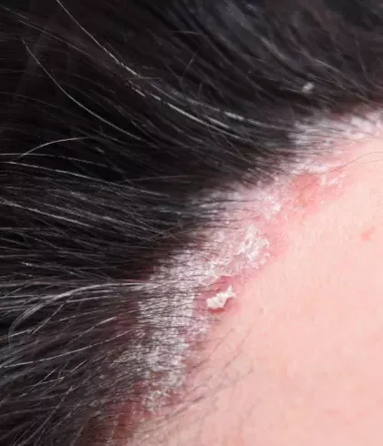 Scalp Psoriasis: Causes & Symptoms | Dr Batra's™ Scalp Psoriasis: Causes & Symptoms | Dr Batra's™
