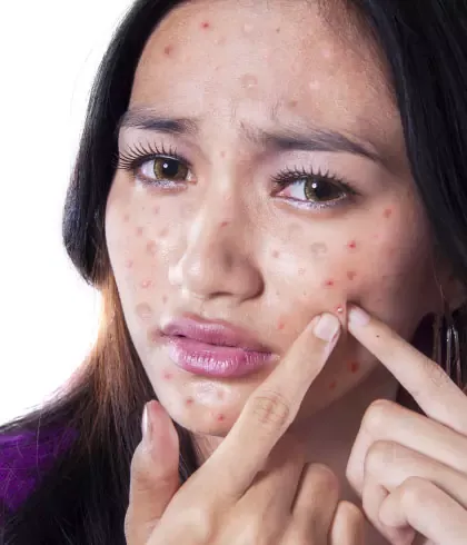 Clear acne with homeopathy