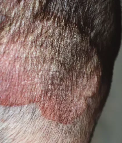 Natural Remedy For Scalp Psoriasis