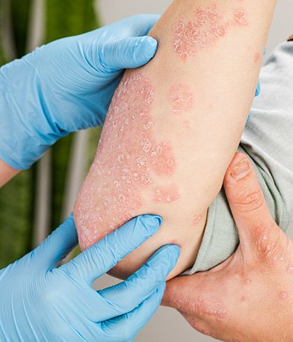 7 reasons why homeopathy is better than psoriasis creams