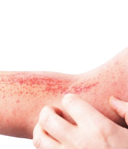How to know if you have atopic eczema?