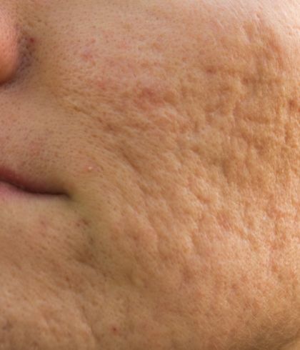 How to reduce acne scars?