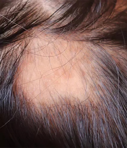 Homeopathy: The best patchy hair loss treatment