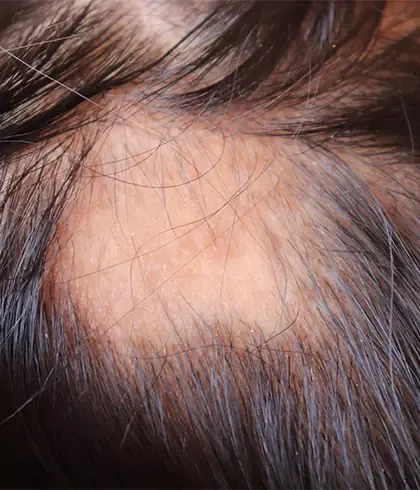 Homeopathy: The best patchy hair loss treatment Homeopathy: The best patchy hair loss treatment