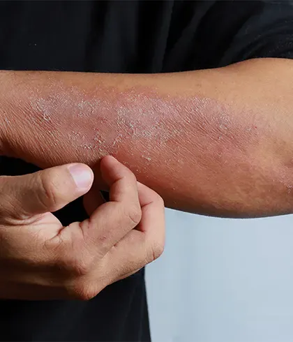 Homeopathy was clinically effective for eczema