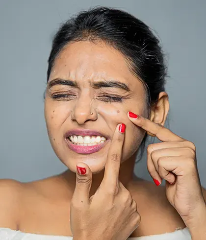 Homoeopathy relieves acne distress safely