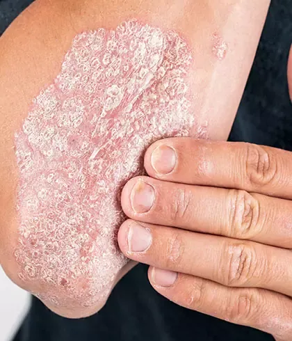 How Psoriasis can be treated by Homeopathy