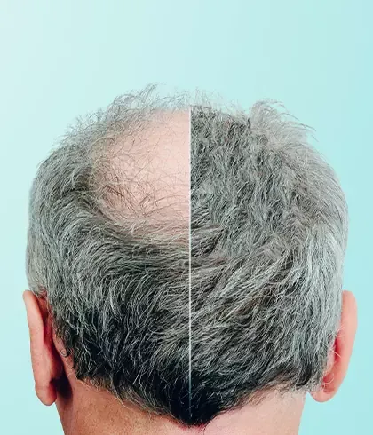 Is hair regrowth possible with homeopathy?