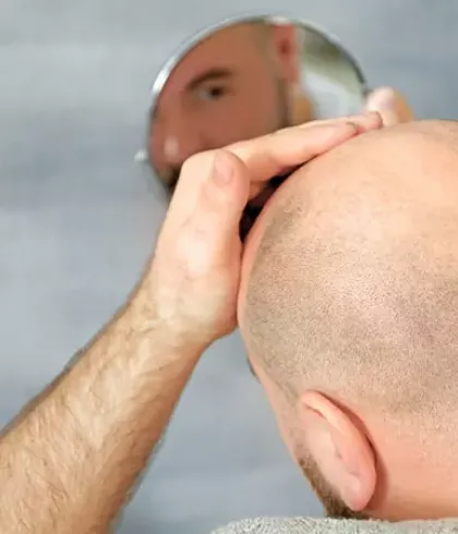 Hair Loss in Men  Male Hair Loss  Cranial Prosthesis Center