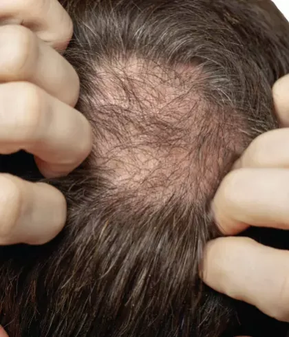 Why do men experience hair fall in the monsoon? - Dr Batra's