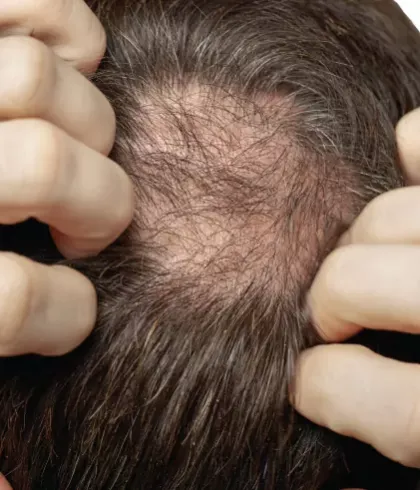 Why do men experience hair fall in the monsoon? - Dr Batra's Why do men experience hair fall in the monsoon? - Dr Batra's