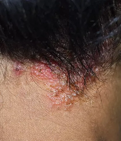 Seborrheic outlet dermatitis treatment