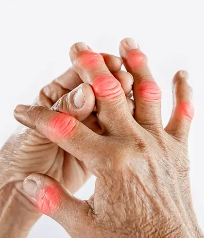 Use homeopathy to ease gout pains