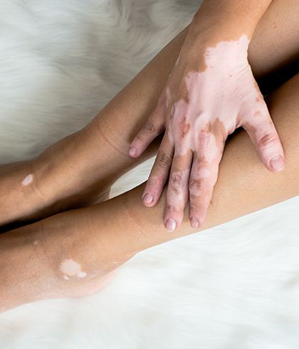 10 common questions about vitiligo