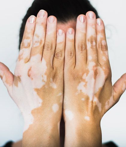 What is the best treatment for vitiligo?