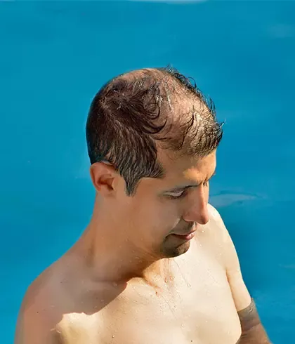 Why Men Experience Hair Loss In Summer? - Dr. Batra's®