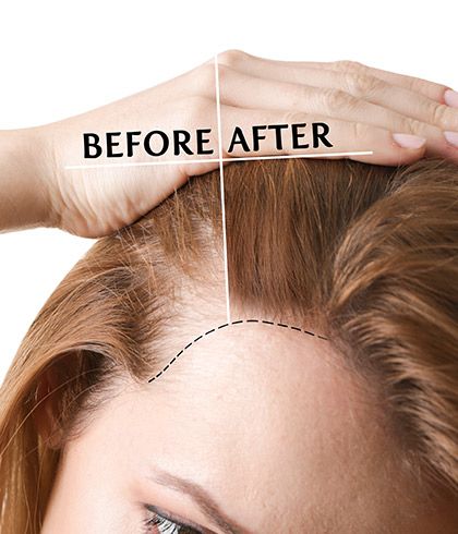 Non-surgical hair replacement vs. Hair laser treatment - Dr Batra's®
