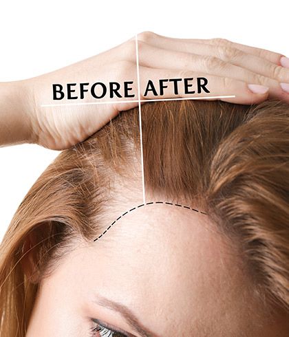 Non-surgical hair replacement vs. Hair laser treatment