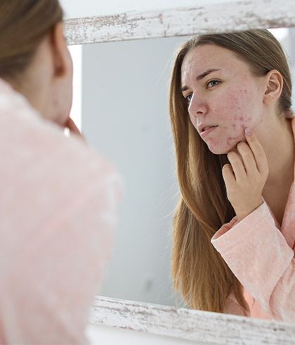 10 facts about acne