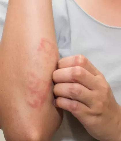 How to get rid of eczema?