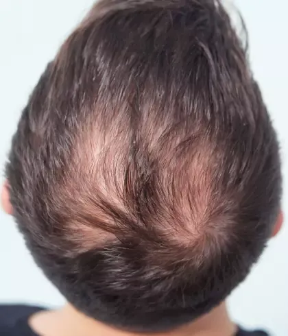 How to Fight Male Pattern Baldness with Homeopathy | Dr Batra's™