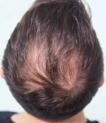How to Fight Male Pattern Baldness with Homeopathy | Dr Batra's™ How to Fight Male Pattern Baldness with Homeopathy | Dr Batra's™