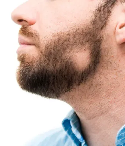 Treat Alopecia Areata with homeopathy | Dr Batra's™ Treat Alopecia Areata with homeopathy | Dr Batra's™