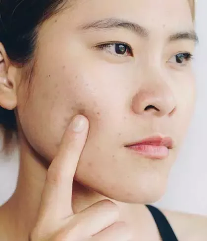 WHY SHOULD YOU CONSULT A HOMEOPATHIC DOCTOR FOR YOUR SKIN PROBLEMS?