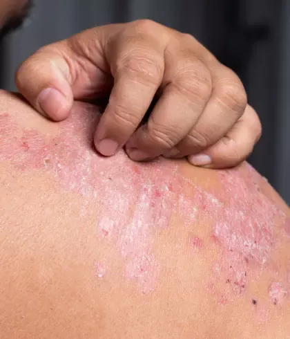How does psoriasis affect the skin?