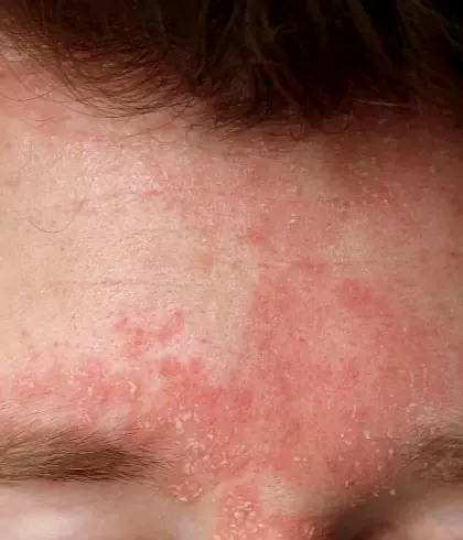 Crusty flaky scalp? It may be Seborrhoeic Dermatitis