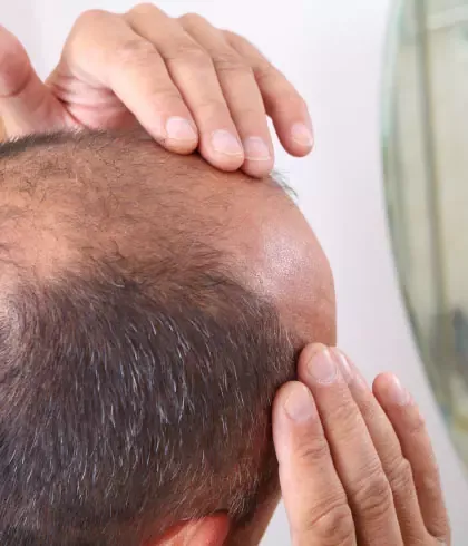 Male pattern hair loss – Symptoms and complications | Dr Batra's™ Male pattern hair loss – Symptoms and complications | Dr Batra's™