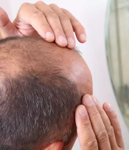 Male pattern hair loss – Symptoms and complications