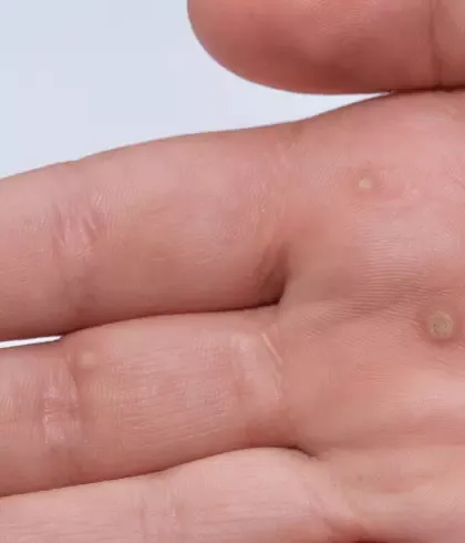 Reasons to treat warts with homeopathy