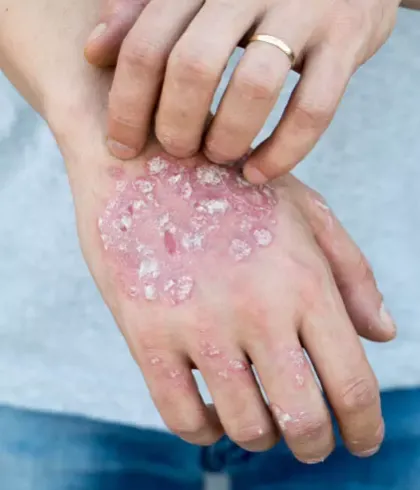 Psoriasis Triggers and Treatments