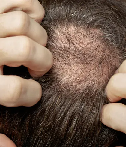 10 Most effective hair loss treatments