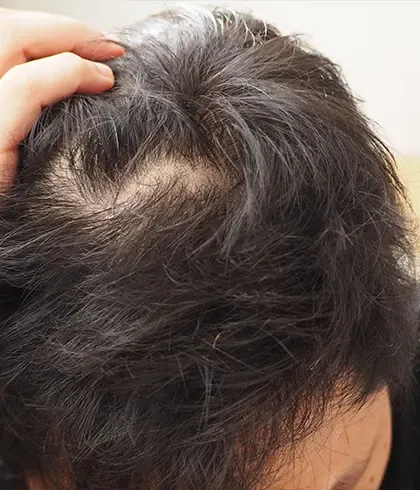 10 Things to know before Dr Batra's® New Hair treatment