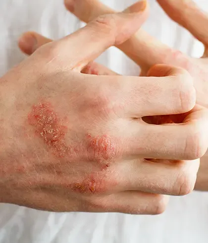 All you need to know about allergic eczema