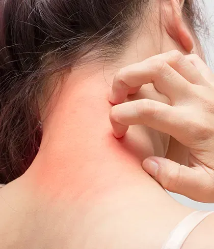 Are skin allergies hereditary?