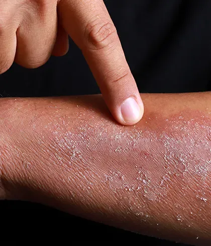 Atopic eczema & allergic rhinitis