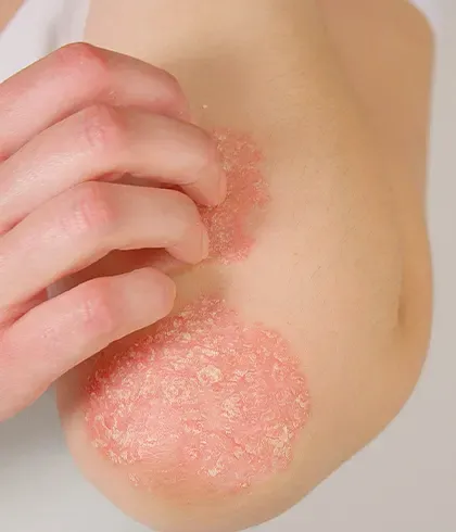 How to care for psoriasis symptoms when the season changes?