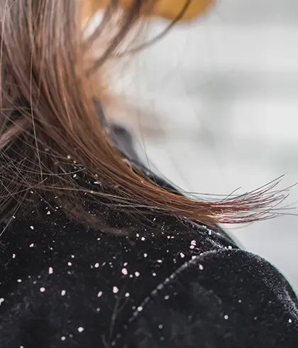 How to control dandruff with Dr Batra's® New Hair treatment?