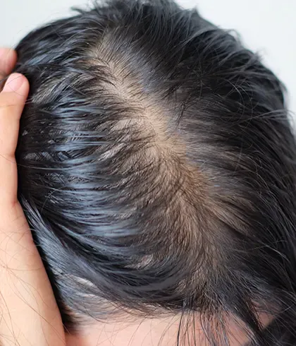 Top 5 hair regrowth success stories