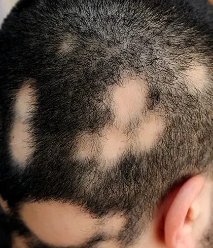 Why does alopecia areata occur?