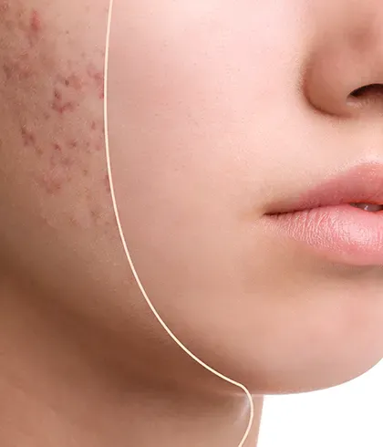 10 things you can do to treat acne